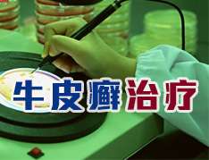 牛皮癬怎么治療比較好