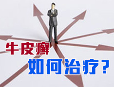 治療牛皮癬需謹慎