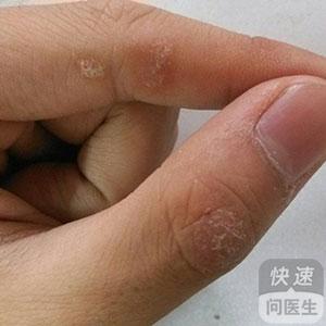如何預(yù)防牛皮癬  牛皮癬怎么治療才好呢