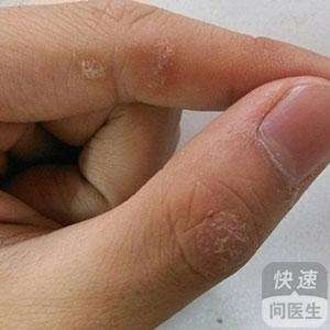 如何預(yù)防牛皮癬  牛皮癬怎么治療才好呢